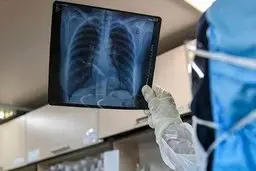 وزیر بهداشت: ‏برای هر بیمار کرونایی بستری شده ۳۰ تا ۴۰ میلیون تومان هزینه می‌شود | قرار بود پرداخت هزینه درمان از جیب مردم به ۲۵ درصد برسد اکنون ۴۵ درصد است