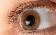 دلایل ایجاد خشکی چشم چیست؟ 