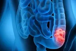 بیماری‌ که زنان ۷ برابر بیش از مردان به آن مبتلا می‌شوند