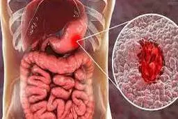 توصیه های مهم برای افرادی که از  بیماری ورم معده رنج میبرند 