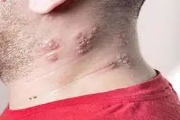 از آبله مرغان تا زونا | افرادی که آبله مرغان گرفته اند مراقب باشند که ویروس زونا در کمین است!