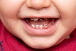 راهکارهای کلیدی پیشگیری از پوسیدگی دندان در کودکان