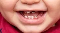 راهکارهای کلیدی پیشگیری از پوسیدگی دندان در کودکان