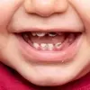 راهکارهای کلیدی پیشگیری از پوسیدگی دندان در کودکان