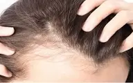 با این روغن از شر ریزش مو خلاص شوید! | بررسی راه‌های درمان ریزش مو