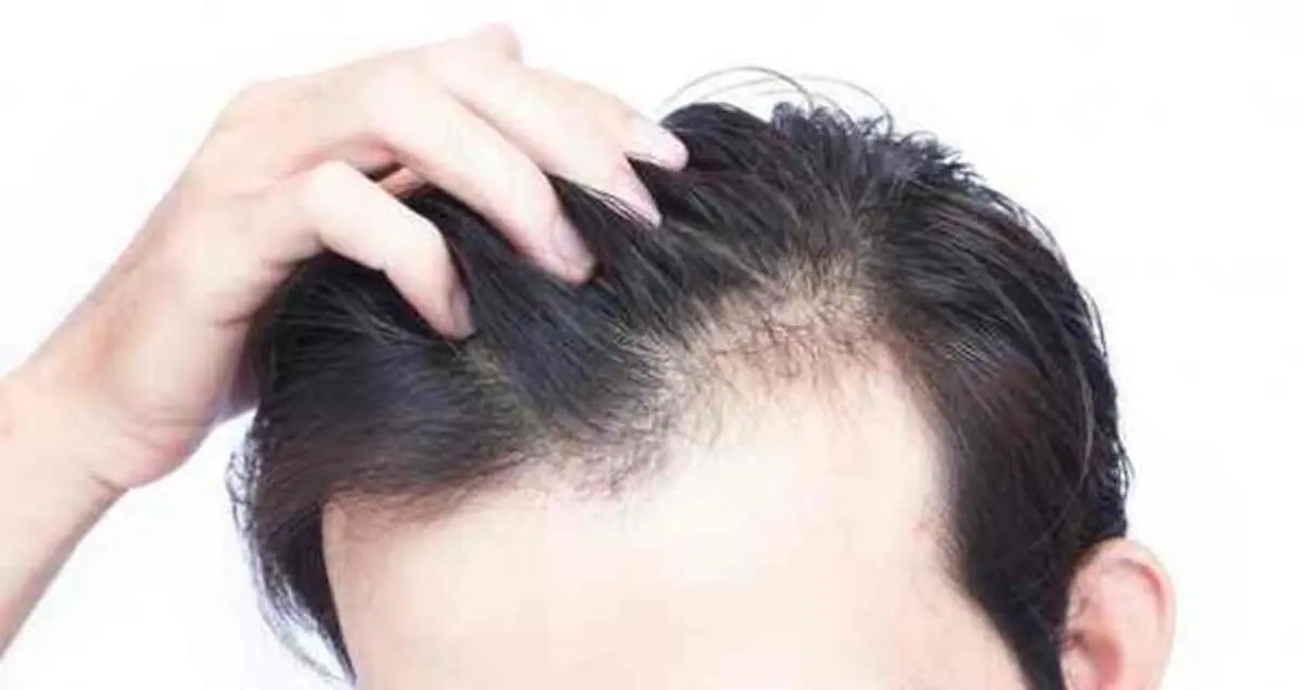 با دلایل مختلفی که موجب ریزش مو در فرد میشودآشنا شوید
