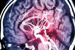 ۷  علائم آلودگی مغز به کووید-۱۹