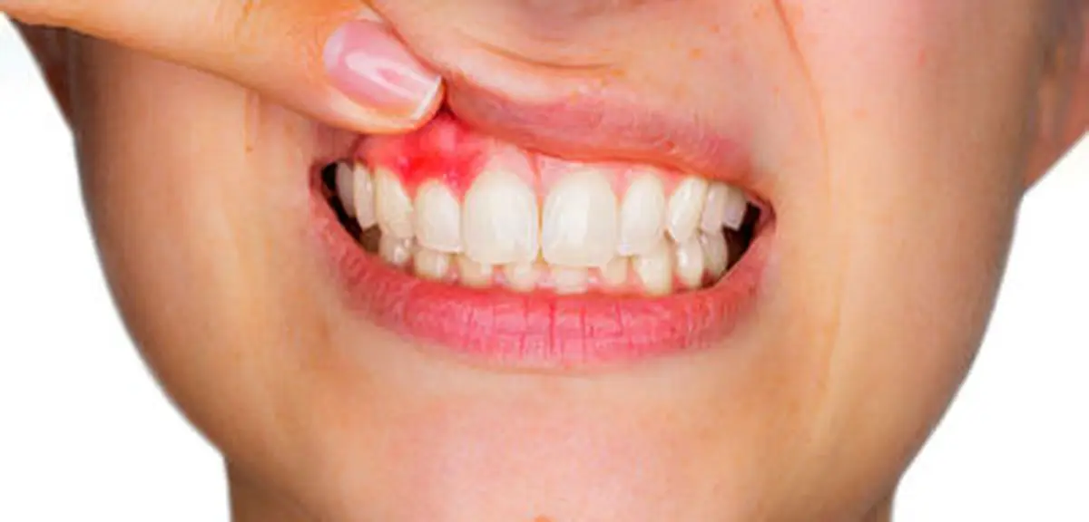 درمان فوری و خانگی آبسه دندان | روش هایی کاربردی برای درمان آبسه در خانه