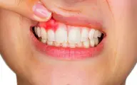 درمان فوری و خانگی آبسه دندان | روش هایی کاربردی برای درمان آبسه در خانه