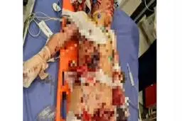 انفجار هولناک مین در یکی از روستاهای سنندج |  مین جنگی در دستان پسر بچه منفجر شد + عکس وحشتناک