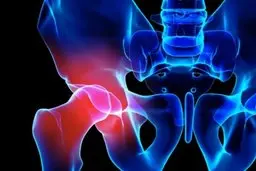 ایران 12درصدشکستگی‌های لگنی جمعیت خاورمیانه رابه خود اختصاص داده است