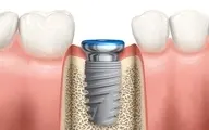 ایمپلنت دندان

