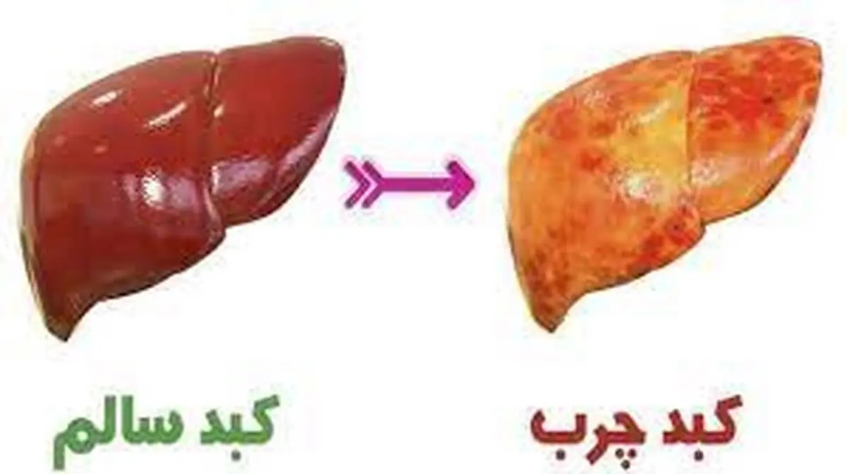 با این روش ساده کبد چرب را درمان کنید | درمان کبد چرب