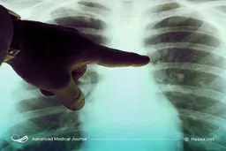 ژن‌هایی که عامل مرگ زودرس افراد مبتلا به سرطان ریه هستند شناسایی شدند