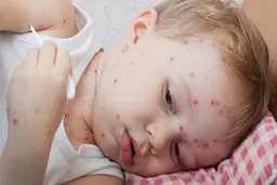 معرفی کامل آبله میمونی | علائم اولیه آبله میمونی | نحوه سرایت آبله میمونی | راه درمان آبله میمونی | آیا در ایران مبتلا شده داریم؟