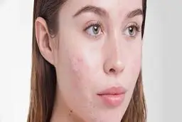 با این ترفند ها جوش صورتت رو در مواقع حساس از بین ببر | چگونه پوست صاف و با طروات داشته باشیم؟+ ویدئو