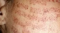 متخصصان: آسیب‌های پوستی از علائم احتمالی ابتلا به کرونا است 