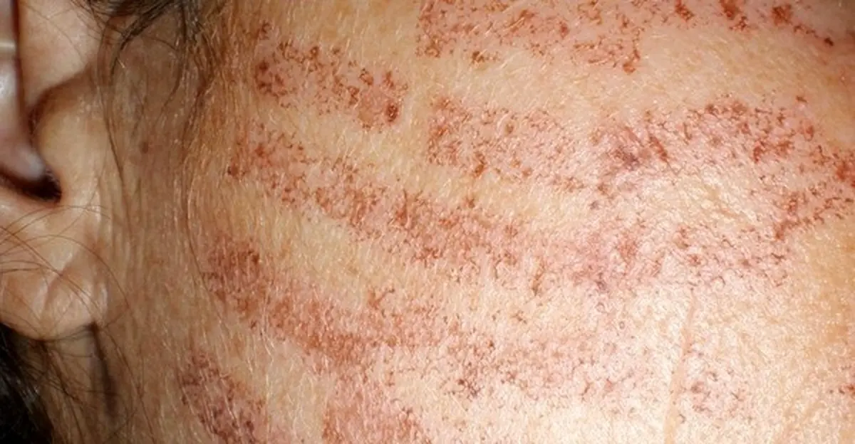 متخصصان: آسیب‌های پوستی از علائم احتمالی ابتلا به کرونا است 