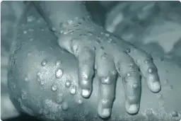 خبر جدید از آبله میمون | راه سرایت بالاخره مشخص شد