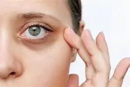 با این ترفند خانگی سیاهی دور چشم رو برای همیشه محو کن| دیگه پولت رو برای کرم‌های گرون هدر نده! +ویدئو