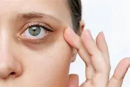 با این ترفند خانگی سیاهی دور چشم رو برای همیشه محو کن| دیگه پولت رو برای کرم‌های گرون هدر نده! +ویدئو