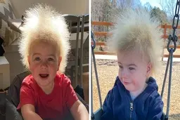 سندرم موی شانه نشدنی | پسری در آمریکا به سندروم موی شانه نشدنی دچار است