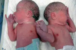 فرار پدر و مادر بعد از مرگ دوقلوها در یک بیمارستان تهران