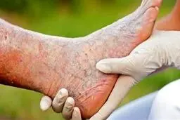 روشی جدید برای درمان واریس 