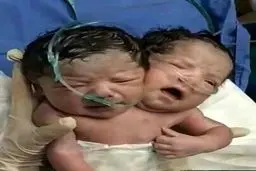 تصویری عجیب از نوزادی که با ۲ سر به دنیا آمد | بدنیا آمدن نوزاد 2 سر آخرالزمانی +عکس