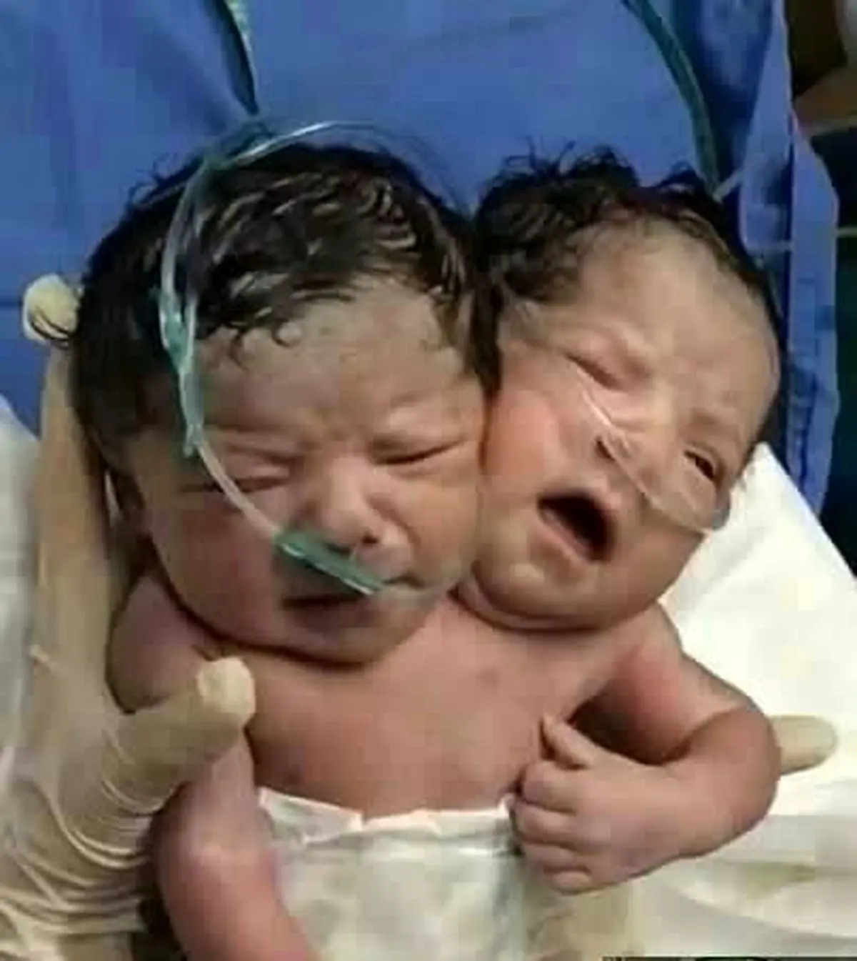 تصویری عجیب از نوزادی که با ۲ سر به دنیا آمد | بدنیا آمدن نوزاد 2 سر آخرالزمانی +عکس