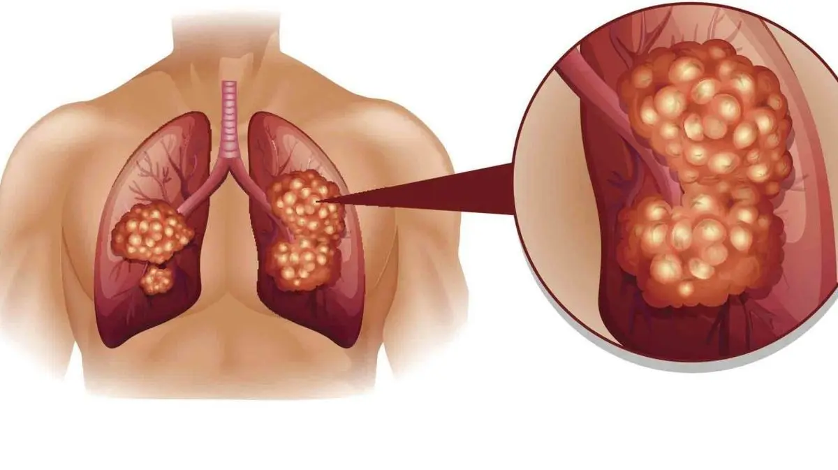  علائم ابتدایی سرطان ریه  | بیماران مبتلا به سرطان ریه طول عمر کوتاهی دارند 