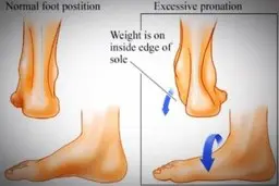 عاداتی که به پاشنه پا آسیب وارد می‌کنند | این کارها را هرگز انجام ندهید