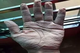 عکس شوکه کننده از دست پرستار بخش کرونا