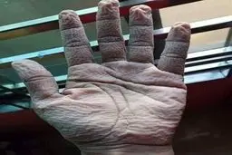 عکس شوکه کننده از دست پرستار بخش کرونا