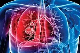  بیماری سل براحتی در هوا شناور می‌ماند مراقب باشید