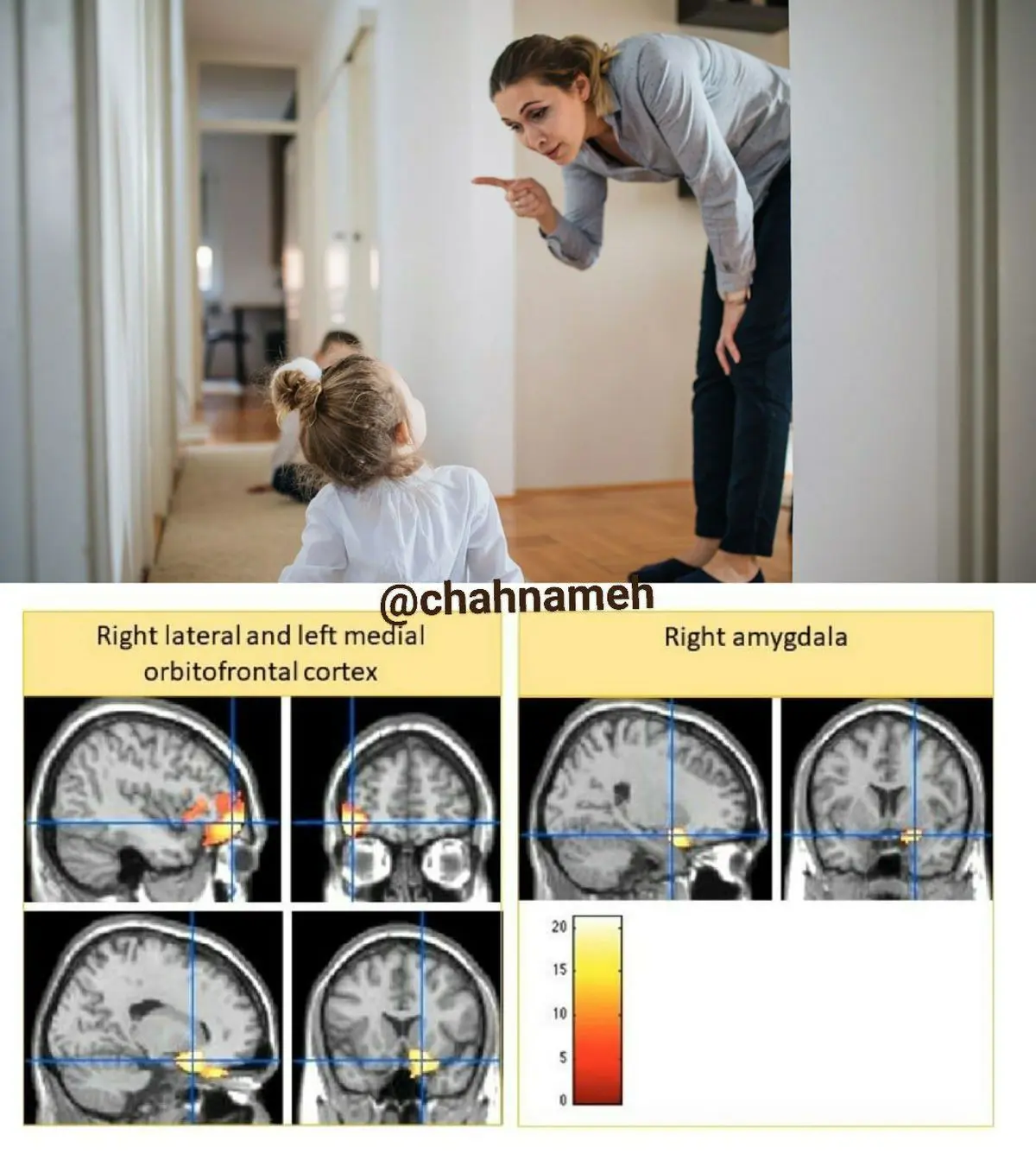 رفتار خشن  والدین نسبت به کودکان  باعث کوچک ماندن قسمتهای از مغز کودکان در جوانی می‌شود!