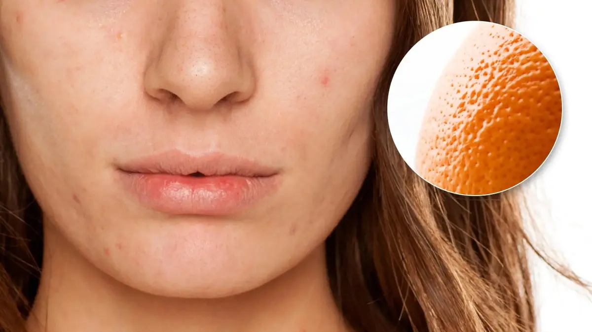 با پوست پرتقالی خداحافظی کن! | معرفی 9 ماسک برای درمان منافذ باز پوست
