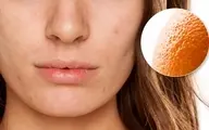 با پوست پرتقالی خداحافظی کن! | معرفی 9 ماسک برای درمان منافذ باز پوست