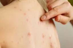 چرا باید از سرخک بترسیم؟ 