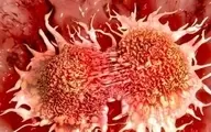 چه چیزی باعث بروز سرطان سینه می‌شود؟