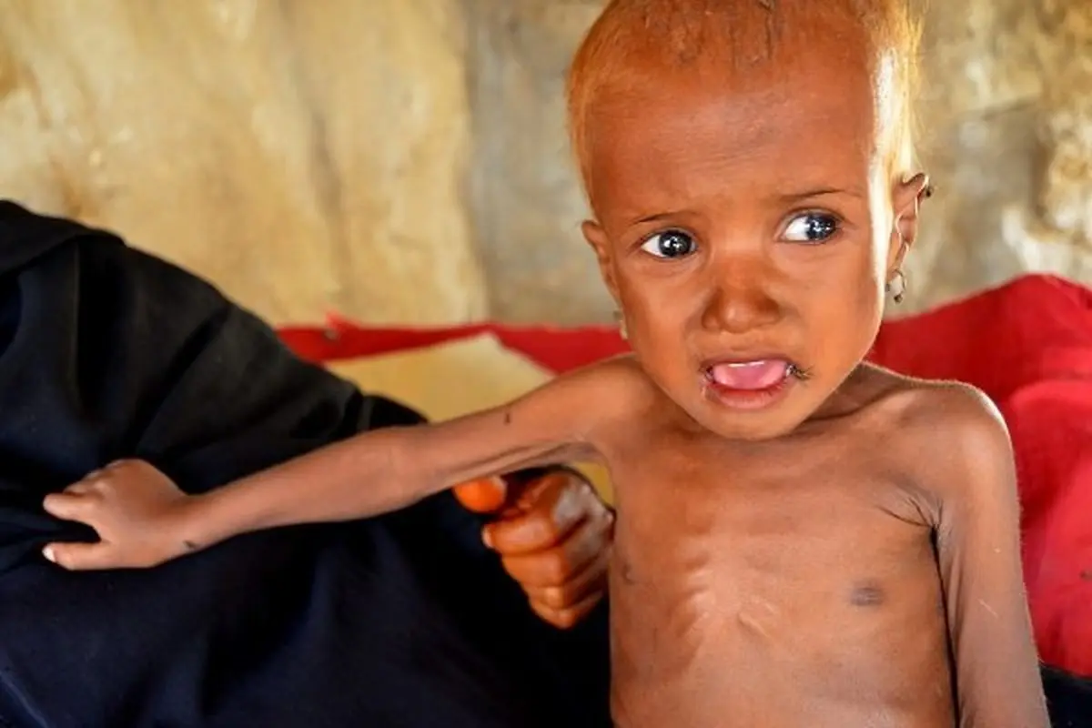 احتمال مرگ بیش از ۵۰ هزار کودک یمنی تا پایان سال