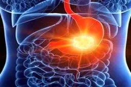 با علائم «سرطان معده» آشنا شوید