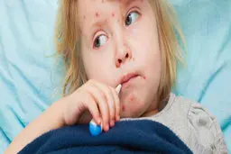 میزان کشندگی آبله میمونی | آبله میمونی در این شرایط کشنده می شود | خطر برای این افراد ،   آبله میمونی نگیرید