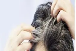 عواملی که سبب سفید شدن زودرس مو می شود 