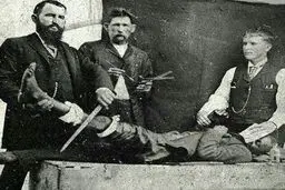 بیهوش کردن بیماران 120 سال پیش برای قطع پا ! 