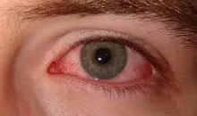 پروتکل حیاتی مراقبت از چشم در بحران و صدمات ناگهانی | هنگام ضربه به چشم در اثر انفجار چه باید کرد؟