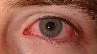 خشکی چشم یک بیماری شایع است | راه های جلوگیری از خشکی چشم