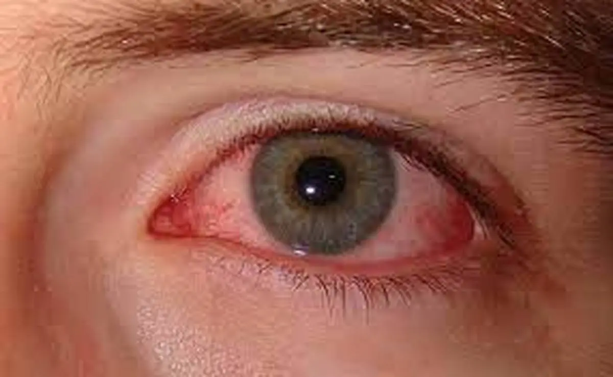 خشکی چشم یک بیماری شایع است | راه های جلوگیری از خشکی چشم