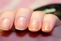 علت تغییر رنگ ناخن چیست؟ | زرد شدن ناخن از هوا نرسیدن به ناخن هست یا قارچ؟