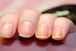 علت تغییر رنگ ناخن چیست؟ | زرد شدن ناخن از هوا نرسیدن به ناخن هست یا قارچ؟